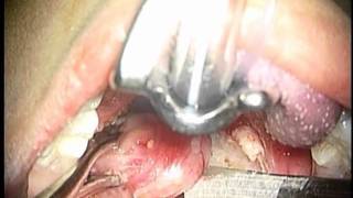 Tonsillectomy for physicians [upl. by Dorraj]