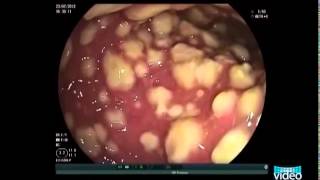 Endoscopic Imaging of Clostridium diffìcile Colitis [upl. by Harness]