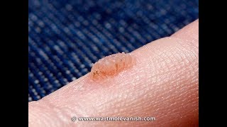 How to Remove Common Hand Warts  Wart amp Mole Vanish [upl. by Pammi385]