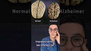 Impactantes diferentes ente un cerebro normal y uno con Alzheimer medicina shorts [upl. by Aniuqaoj714]