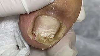 PEELING MEGA SATISFATÓRIO [upl. by Nabetse]