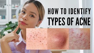 How to treat EVERY type of acne With Pictures [upl. by Morganstein]