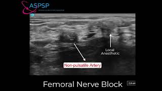 Femoral Nerve Block in an Amputee [upl. by Ahsinauq]