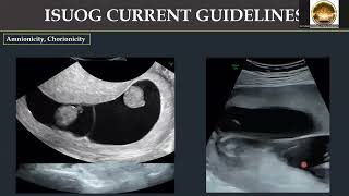 Applying Updated 2023 ISUOG Practice Guidelines in 11 14 Weeks Scan Part 1 By DrRaghavendra [upl. by Larimore995]