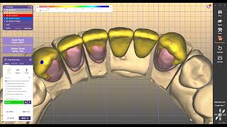 design dental crovn coping foe metalo ceramic design exocad 3 2 elefsinaexocad [upl. by Ardnaiek]