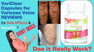 Variclear Capsules for Varicose Veins Reviews Does it Really Work Side Effects [upl. by Ahsekat]