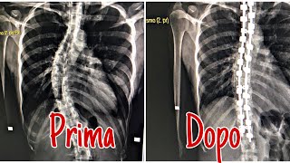 SCOLIOSI 1 ANNO DOPO L OPERAZIONE DI FUSIONE SPINALE [upl. by Kcirej]