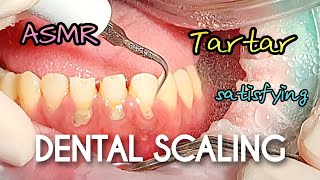 ASMR Very Satisfying Dental Scaling [upl. by Reklaw]