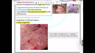 Pathology  Hemodynamic disorders 1  Mutah [upl. by Orgel]