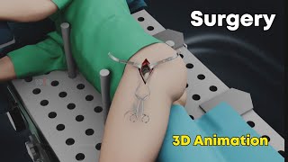 SuperPath Hip Replacement Surgery  3D Animation [upl. by Paske]