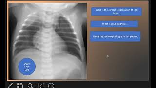 OSCE CASE 002  Pneumothorax left side and Pneumomediastinum [upl. by Amehsyt]