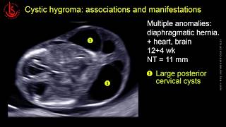 Cystic hydroma and nuchal edema at 1113 weeks of pregnancy [upl. by Ynez]