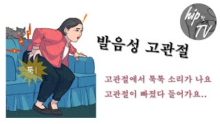 고관절에서 소리가 나요 발음성 고관절이란 [upl. by Essej]