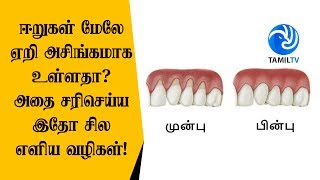 ஈறுகள் மேலே ஏறி அசிங்கமாக உள்ளதா அதை சரிசெய்ய இதோ சில எளிய வழிகள் [upl. by Essiralc34]