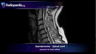 Spinal ependymoma  radiology video tutorial MRI [upl. by Eben]