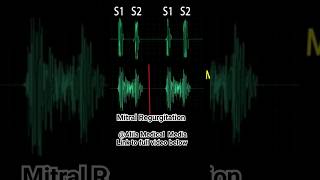 Heart Murmurs Mitral Valve Regurgitation heartmurmurs medicalanimation [upl. by Lamag]