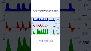 Patient Ventilator Asynchrony Auto Triggering [upl. by Fellows]