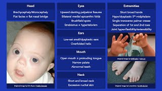 Down Syndrome Dysmorphic Features [upl. by Ainomar685]