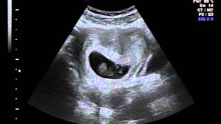 Vanishing Twin 10 week ultrasound [upl. by Etnelav]