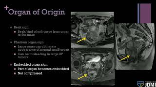 03 Approach to Peritoneal and Retroperitoneal Masses [upl. by Grevera83]