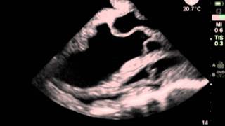 Transesophageal Echo and Transthoracic Echo Training Model [upl. by Azila]