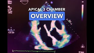 Apical 3 Chamber View  Echocardiography Education [upl. by Ioyal]