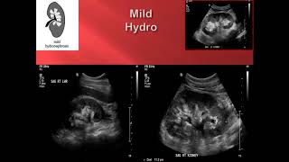 Hydronephrosis Point of Care Ultrasound [upl. by Schrick669]