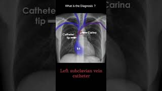 Left subclavian vein catheter 191 chest Xray tubes Quiz radiologychannel007 [upl. by Carolee]