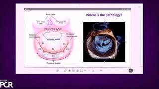 Treating diverse mitral regurgitation anatomies the power of versatility  EuroPCR 2023 [upl. by Eiralc]