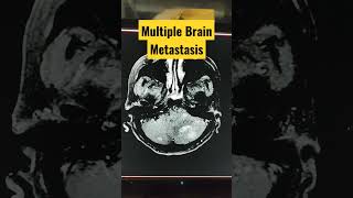 Multiple Brain Metastasis shorts mri radiology [upl. by Nylirehs590]