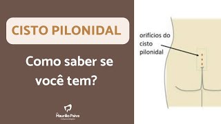 Cisto pilonidal como saber se você tem [upl. by Fronniah]