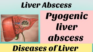 Liver Abscess pyogenic abscess with notes bamsfinalyear shalyatantra surgery bams4thyear bams [upl. by Burty]