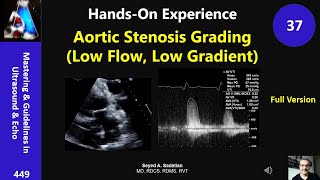 HandsOn Experience 37 Aortic Stenosis Grading Low Flow Low Gradient [upl. by Rist]