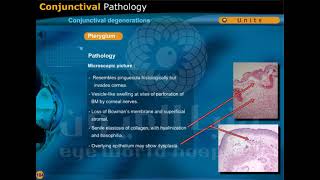 conjunctival degenertions and conjunctival cysts [upl. by Red]