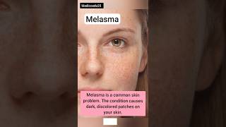 Melasma क्या है  pictures [upl. by Ventura]