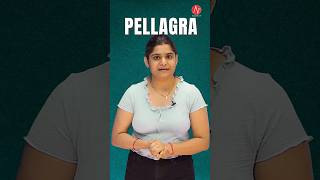 Pellagra  Ms Mithlesh  NORCET 70 amp 80  Biochemistry amp Nutrition  Nursing Next Live pellagra [upl. by Samella]