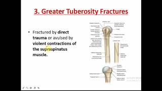 GREATER TUBEROSITY FRACTURE OF HUMERUS [upl. by Reaht]