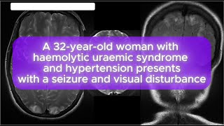 Case 123 A 32yearold woman with haemolytic uraemic syndrome and hypertension [upl. by Onimixam]