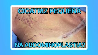 CICATRIZ PEQUENA NA ABDOMINOPLASTIA O QUE VOCÊ PRECISA SABER  CIRURGIA PLÁSTICA [upl. by Airotahs]