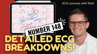 EKG Test Yourself  ECG Case Study 148 [upl. by Annelg]