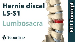 Hernia discal lumbar entre la L5 y S1 o quinta vértebra lumbar y el sacro [upl. by Dunkin]