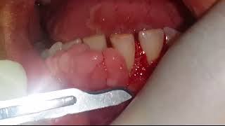 Gingivectomy for a drug induced gingival enlargement [upl. by Marlin]