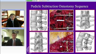 Spinal Deformity Evaluation and Surgical Treatment  Part II Preview [upl. by Misak]