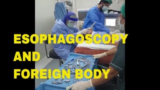 Covid and Esophagoscopy  Endoscopy and Foreign Body removal  Dr Sultan Badar Munir  Endoscopy [upl. by Anaugahs]