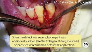 JCPARKLAND Lecture 5  Emdogain  BioOss Collagen saving a hopeless tooth [upl. by Jenkins674]