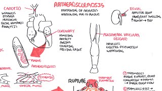 Atherosclerosis  Pathophysiology [upl. by Tsepmet]