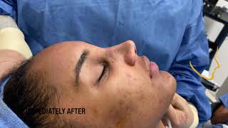 Rhinoplasty For A Wide Nose and Drooping Nasal Tip South Florida Rhinoplasty Surgery [upl. by Mandle]