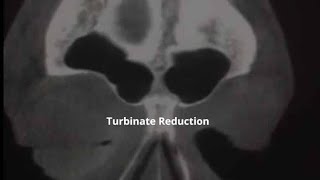 Turbinate Reduction Before amp After  ENT New Orleans Metairie Chalmette  GNO Snoring amp Sinus [upl. by Annwahsal570]