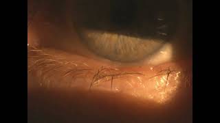 trichiasis misdirected eyelash [upl. by Htennaj]