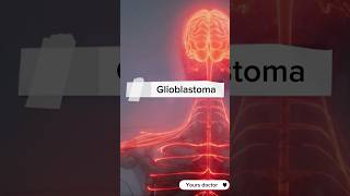 Glioblastoma or GBM  the aggressive brain tumor glioblastoma gbm brain tumores cancer [upl. by Padget107]